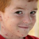 Come trattare il varicella?
