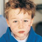 Mollusco contagiosum nei bambini Mollusco contagiosum nei bambini