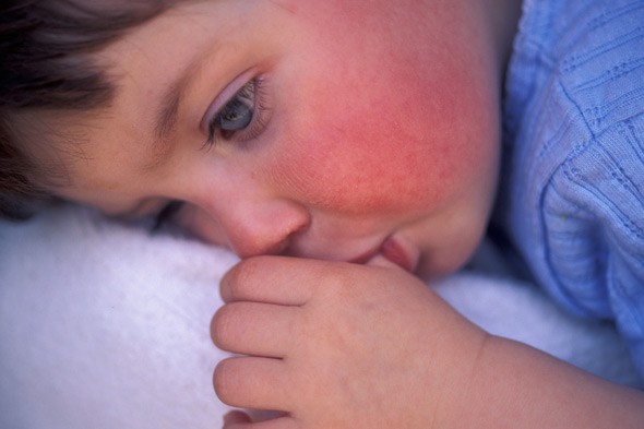 inizia il peeling della pelle