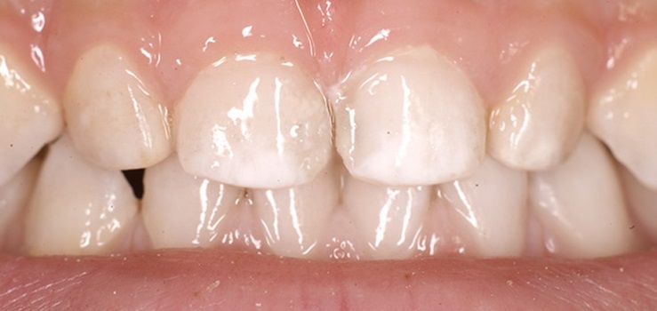 Come affrontare macchie bianche sui denti