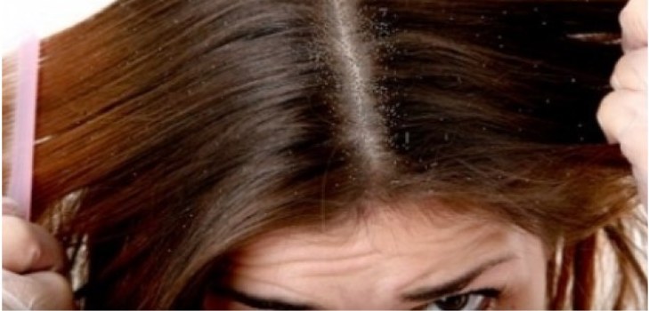 capelli con forfora