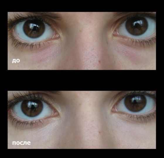 Trucco permanente per nascondere i lividi sotto gli occhi