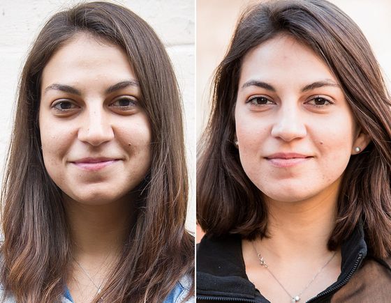Trucco permanente per nascondere i lividi sotto gli occhi