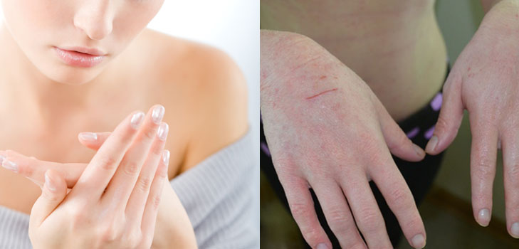 Crepe nelle mani: le cause di apparenza e di trattamento con rimedi domestici