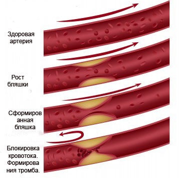 Trattamento di aterosclerosi con rimedi popolari