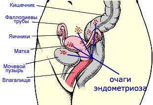 Endometriosi: trattamento con rimedi popolari