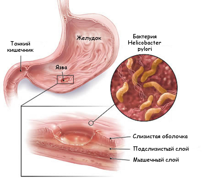 Trattamento di ulcere gastriche con rimedi popolari
