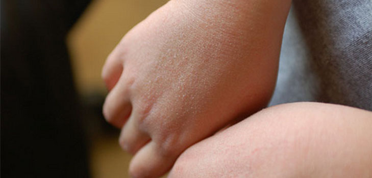 Ci liberiamo di rossore e rugosità sulle mani del bambino