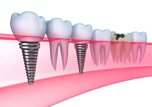 L'impianto dentale è un lusso o una necessità? 