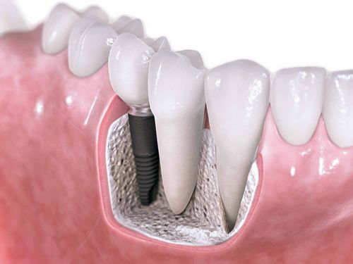 L'impianto dentale è un lusso o una necessità? 