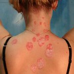 Come trattare la psoriasi? Come trattare la psoriasi?