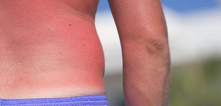 La pelle è bruciata dal sole. Cosa dovrei fare? Ricette, maschere, consigli