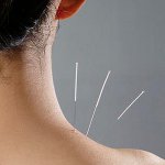 Trattamento con l'agopuntura Trattamento con l'agopuntura