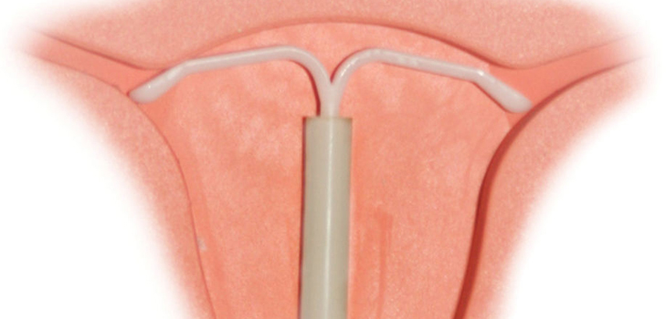 È possibile mettere un dispositivo intrauterino per le donne nulliparose
