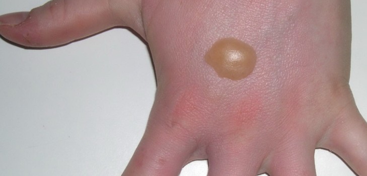 Sul palmo delle tue mani apparvero delle bolle acquose: cosa fare