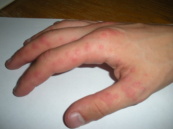 Sul palmo delle tue mani apparvero delle bolle acquose: cosa fare