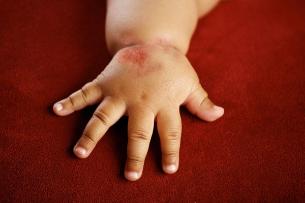 Sul palmo delle tue mani apparvero delle bolle acquose: cosa fare