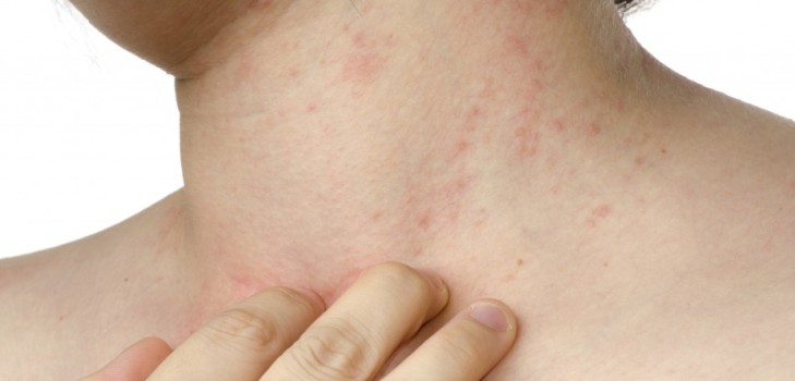 Che cosa provoca un rash sul collo: le principali cause e metodi di trattamento