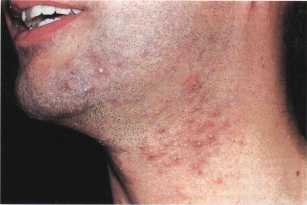 Che cosa provoca un rash sul collo: le principali cause e metodi di trattamento