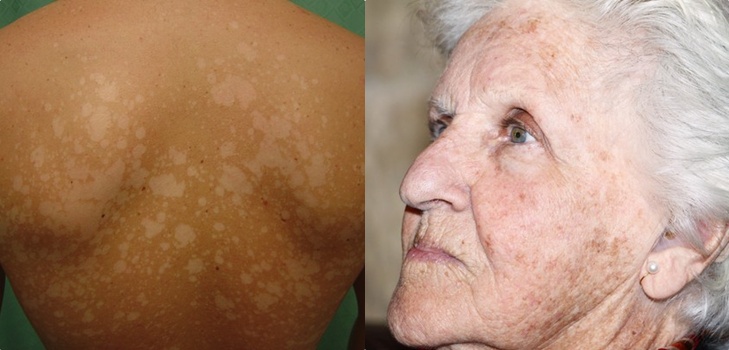 Sulla pelle un peeling