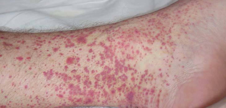 Vasculite - che cos'è? Sintomi, foto, trattamento